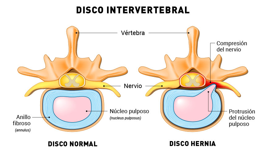 Esquema de una hernia discal